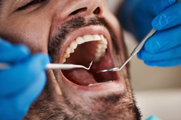Best Emergency Wisdom Teeth Removal in Todd Creek, CO